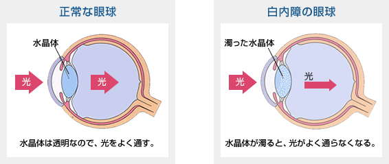 白内障の症状